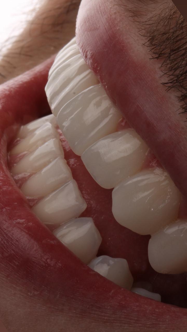 Comparação de cores para facetas